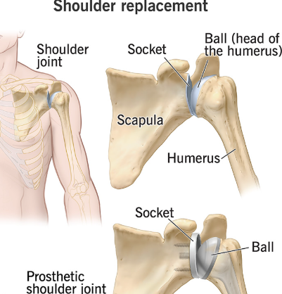 Total Shoulder Replacement