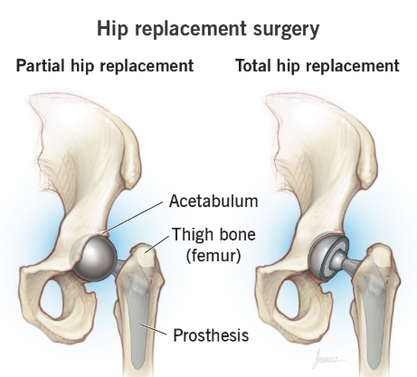 Total Hip Replacement
