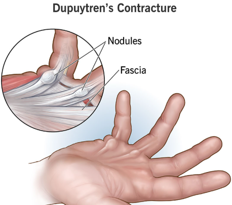 Dupuytren’s Contracture Release