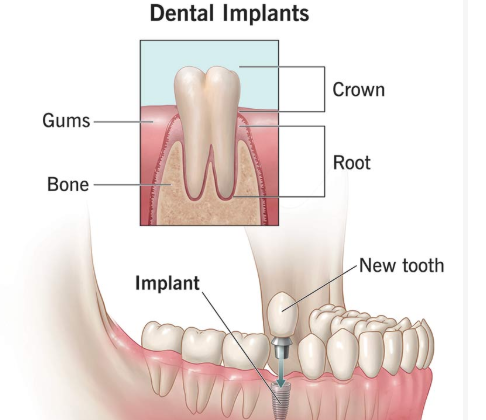 Dental Implants